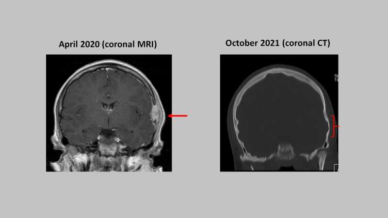 In brief: Surgery may be avoided for children with rare skull tumor