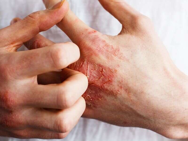 Inflammatory skin diseases classified at molecular level