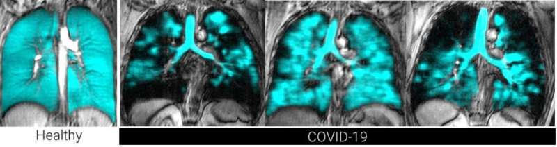 Innovative lung-imaging technique shows cause of long-COVID symptoms