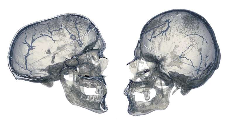 Investigating the diploic veins in skulls with premature suture fusion