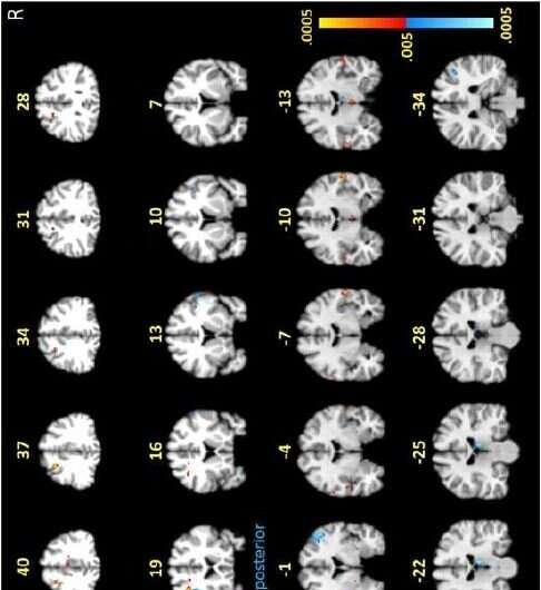 Johns Hopkins neuroimaging study reveals functional and structural brain abnormalities in people with post-treatment Lyme diseas