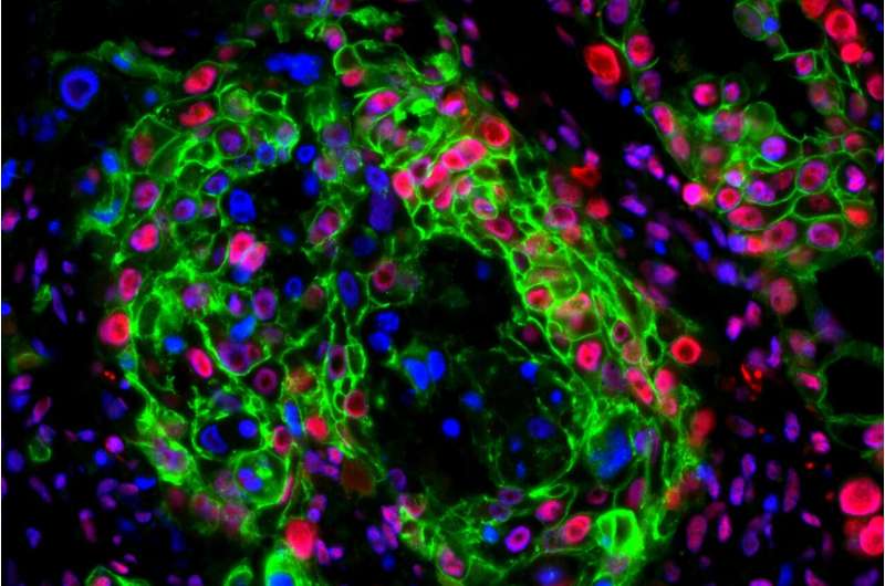Lab results show promise for future pancreatic cancer treatment