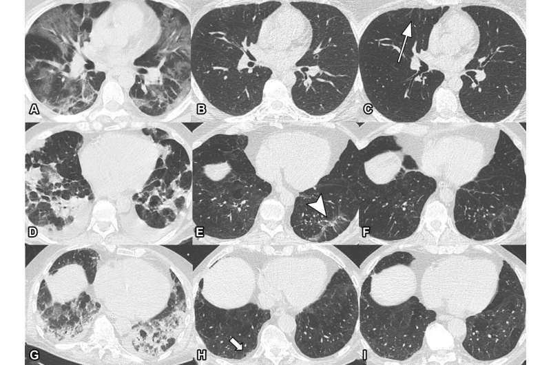 Lung damage may persist long after COVID-19 pneumonia
