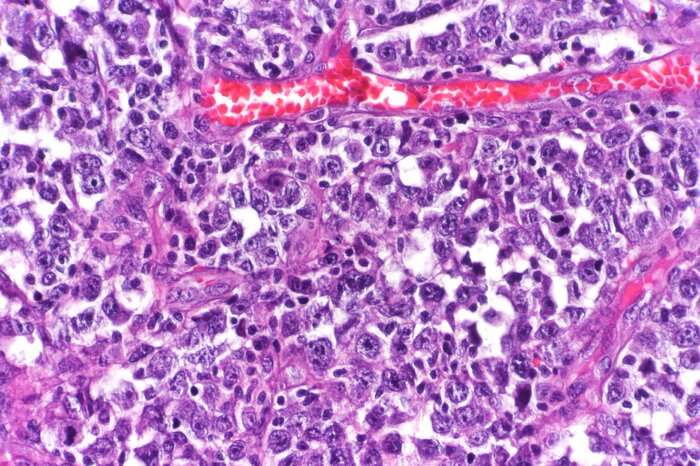 Lymphoma cell metabolism may provide new cancer target