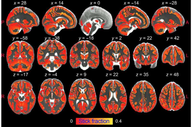 Magnetic resonance imaging shows brain inflammation in vivo for the first time