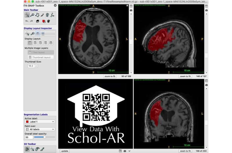 Major expansion of open-source neuroimaging data set to boost stroke recovery research