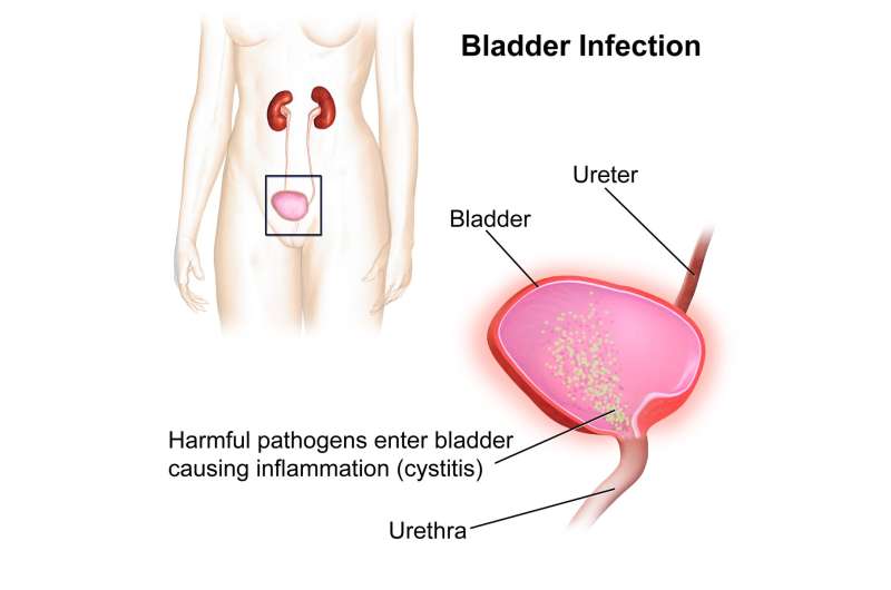 Mayo Clinic Q and A: How to treat painful bladder syndrome