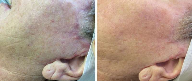 Microneedling improves appearance of surgical scars—especially if performed early