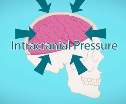 Modernizing intracranial pressure sensing methods