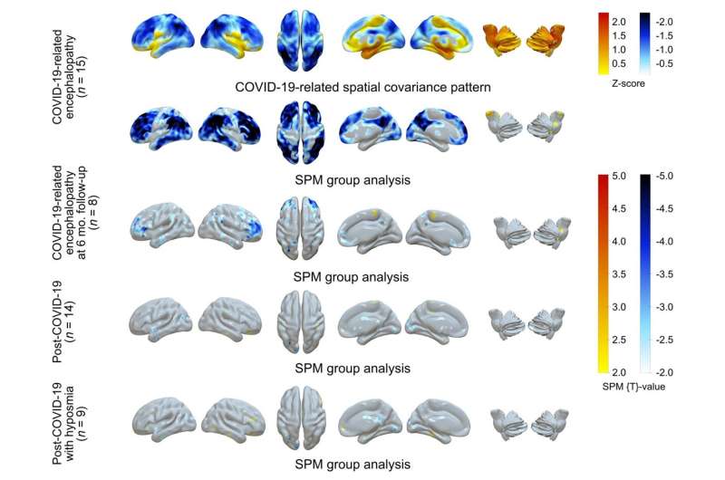 Molecular imaging uncovers effects of COVID-19 on the brain