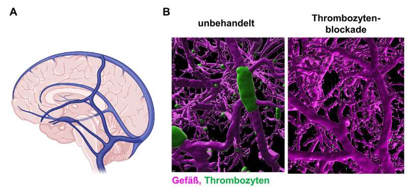 Molecular mechanism of cerebral venous thrombosis discovered