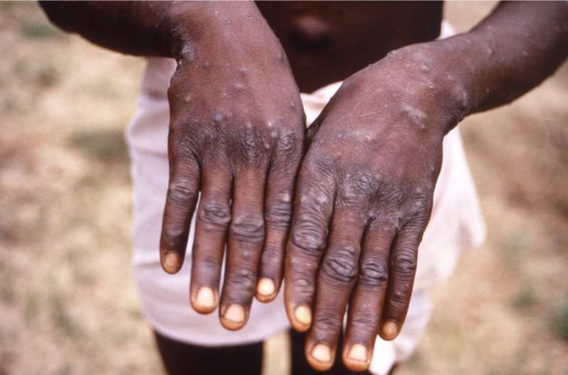 Monkeypox in Australia: what is it and how can we prevent the spread?