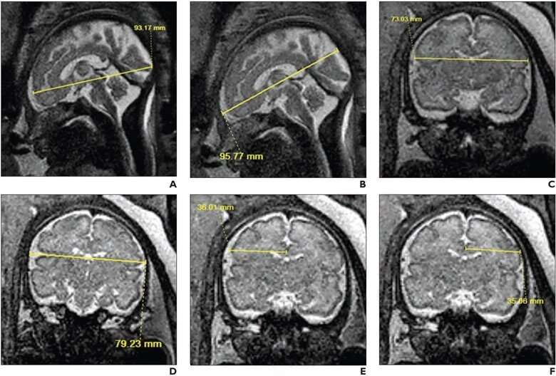暴露于阿片类药物的胎儿的MRI结果显示大脑体积更小