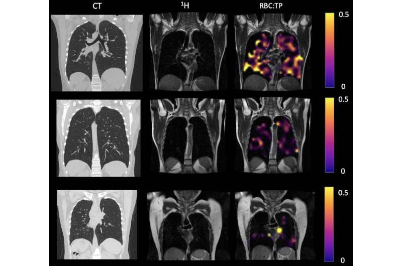 MRI Finds Lung Abnormalities in Non-Hospitalized Long COVID Patients