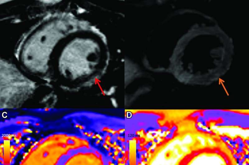 MRI sheds light on COVID vaccine-associated heart muscle injury