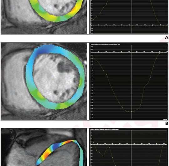 Myocardial strain parameters on MRI in patients with dilated cardiomyopathy