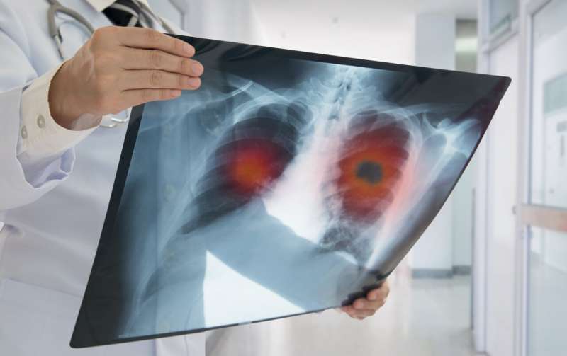 Nearly half of patients at high risk for lung cancer delayed screening follow-up