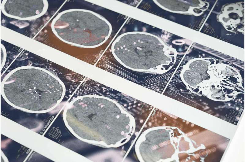 Neuroscientist thinks her AI for brain bleeds can beat human assessments