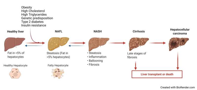 New Chinese Medical Journal review elucidates potential contributors to non-alcoholic fatty liver disease