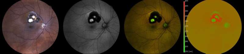 New diagnostic option for rare eye disease