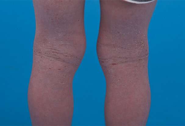 New drug therapy for young children with severe eczema