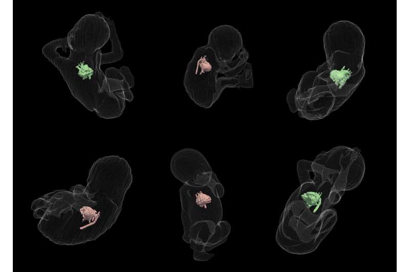 New fetal shape analysis can predict need for baby's life-saving surgery