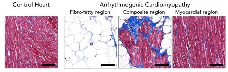 New gene identified in arrhythmogenic cardiomyopathy