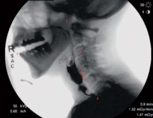 New guidelines laid out to standardize swallowing fluoroscopy