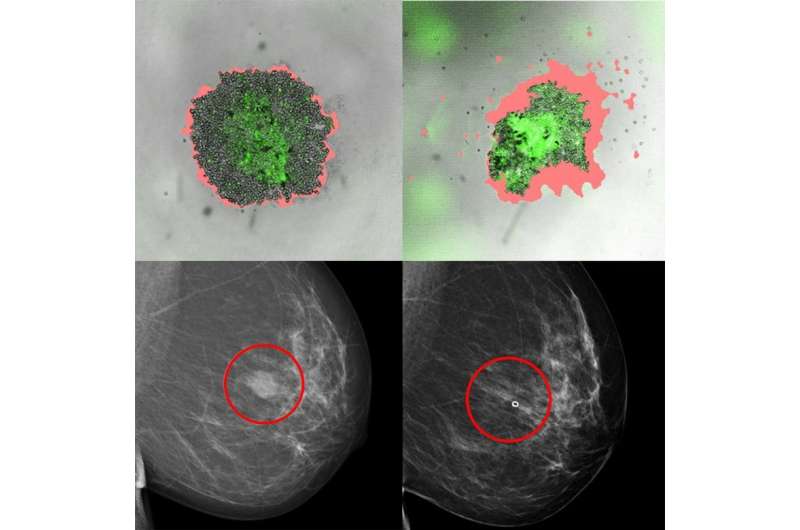 新方法预测乳腺癌患者的正确治疗方法