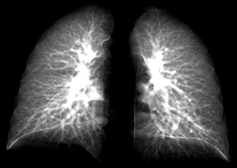 New model can detect long-COVID's effects using simple, 2D chest X-rays