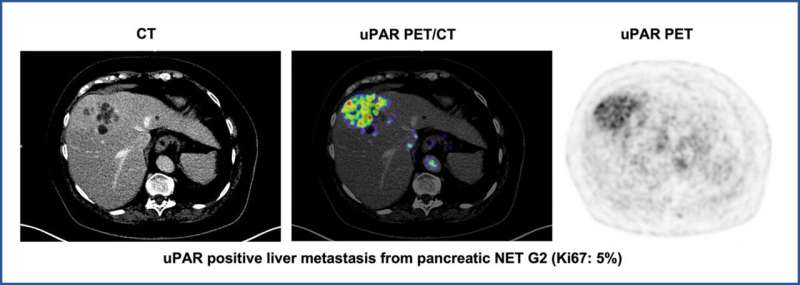 New PET tracer shows promise for uPAR-targeted therapy of neuroendocrine neoplasms