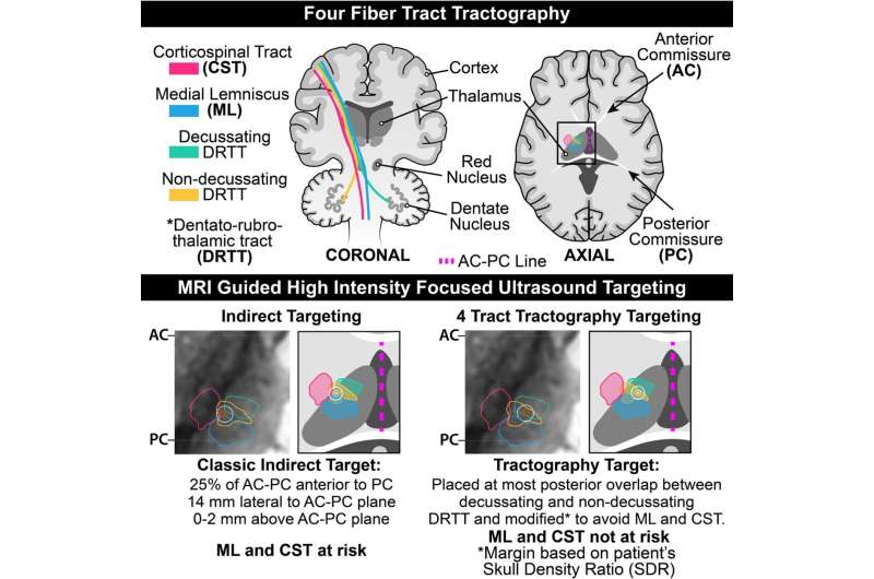 New technique improves high-intensity focused ultrasound treatment for brain disorders