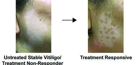 مطالعه جدید تحت رهبری UCI ویژگی های بیماری پوستی پایدار ویتیلیگو را نشان می دهد