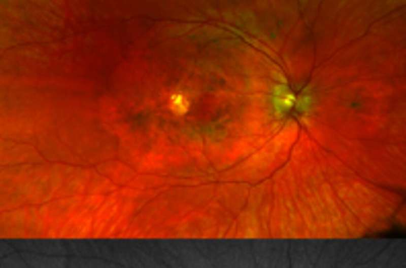 NIH researchers discover new genetic eye disease