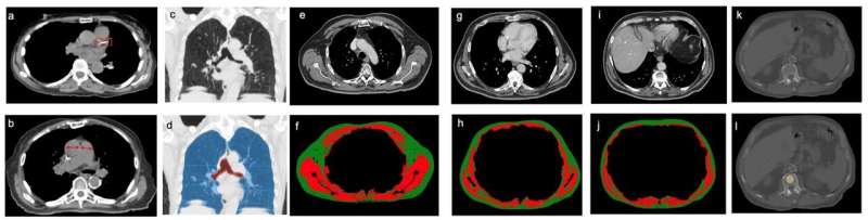 Noncancerous chest CT features for predicting survival in stage I lung cancer