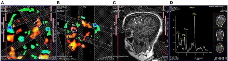 Novel brain imaging study seeks answers to chronic fatigue mystery