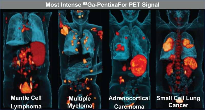 Novo agente PET detecta efetivamente vários tipos de câncer e identifica pacientes para terapias direcionadas