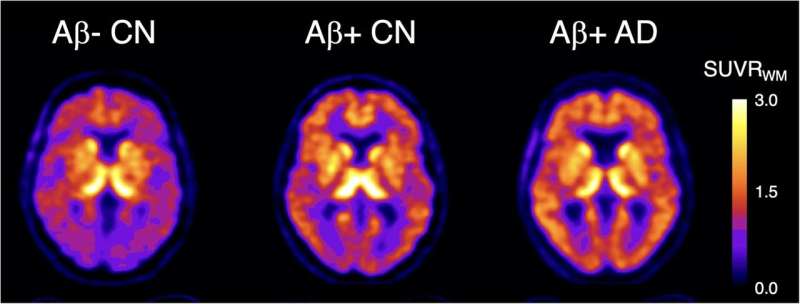 Novel PET Imaging Agent Detects Earliest Signs of Alzheimer's Disease