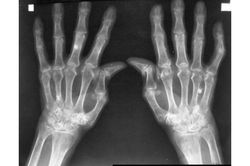 Novel study identifies key molecular players in rheumatoid arthritis