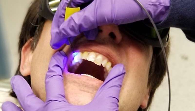 O-pH, a new UW dental tool prototype, can spot the acidic conditions that lead to cavities