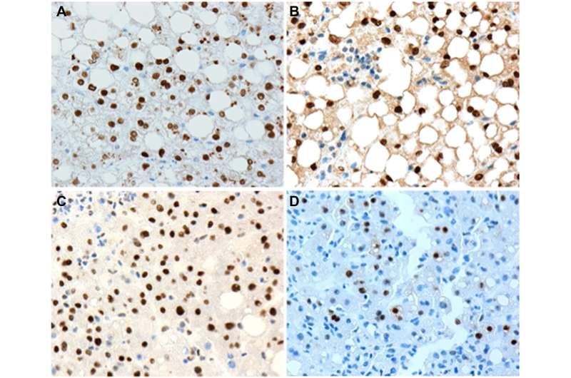 Oncotarget | Expression of p-STAT3 and c-Myc correlates with P2-HNF4α expression in nonalcoholic fatty liver disease (NAFLD)