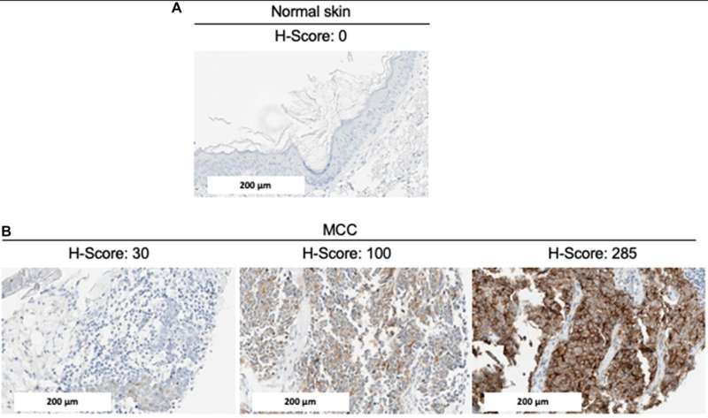 Oncotarget | Glypican-3 (GPC3) is associated with MCPyV-negative status and impaired outcome in Merkel cell carcinoma