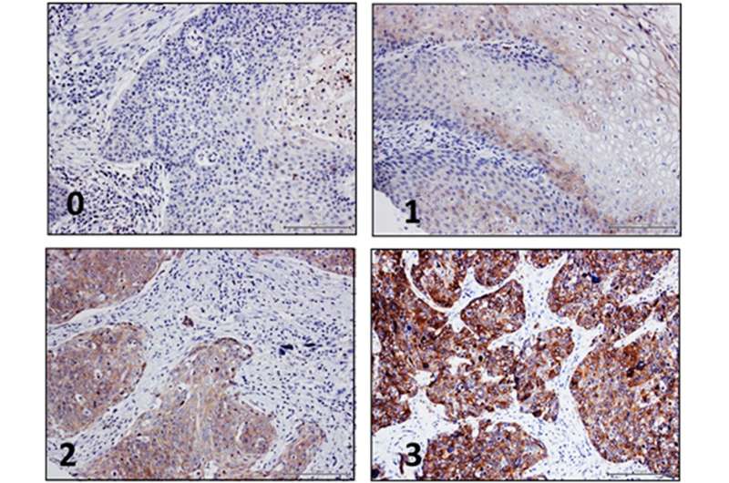 Oncotarget | Nectin-4 is widely expressed in head and neck squamous cell carcinoma