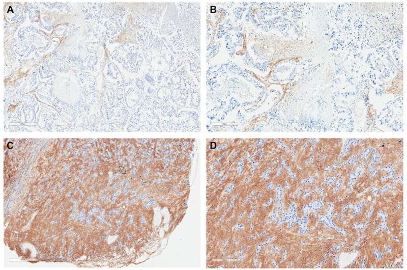 Oncotarget | Tumor hyaluronan as a novel biomarker in non-small cell lung cancer: A retrospective study