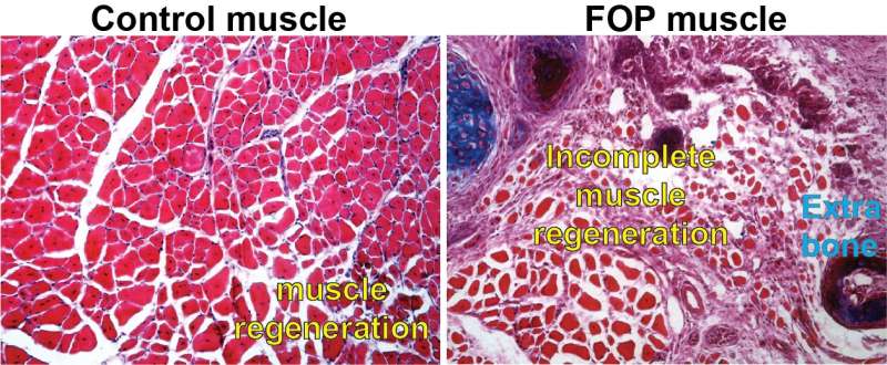 منشأ بیماری نادر FOP که ریشه در اختلال در بازسازی عضلات دارد
