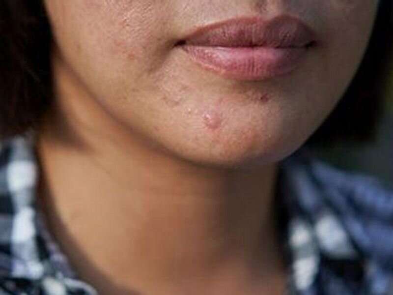 Overall risk for acne comparable for adults with dermatitis, controls