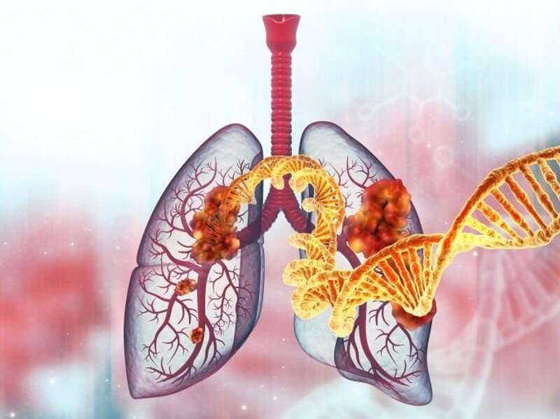 Pathogenic germline variants ID'd in patients with lung cancer
