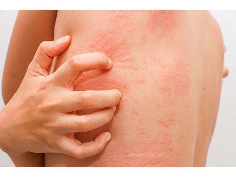 Patients with inflammatory skin diseases have high stress scores