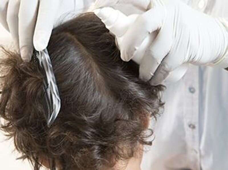 Pediatricians offer latest advice on controlling head lice in kids
