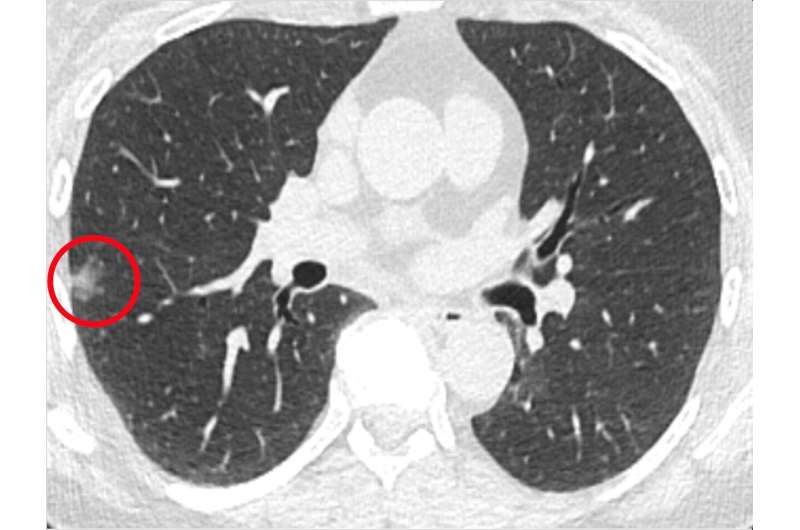 Penn Medicine study reveals imaging approach with potential to detect lung cancer earlier, at the cellular level